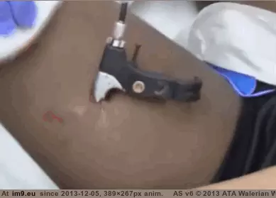#Wtf #Out #Hand #Bicycle #Brake #Leg #Doctor #Pulls [Wtf] Bicycle hand brake to the leg, doctor pulls it out GIF (Image de album My r/WTF favs))