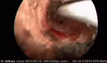 #Wtf #Ear #Cockroach #Removed #Mans [Wtf] Cockroach removed from mans ear GIF (Image of album My r/WTF favs))