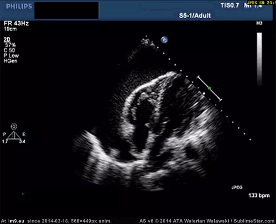 #Wtf #Heart #Severe #Effusion #Pericardial #Result #Swinging [Wtf] Swinging Heart, result of a severe pericardial effusion GIF (Image de album My r/WTF favs))